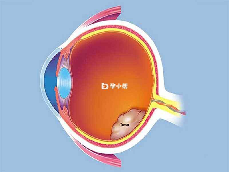 视网膜母细胞瘤
