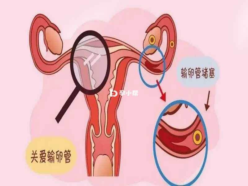 输卵管阻塞可行有效的方法就是手术