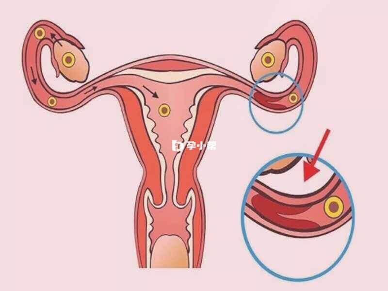 输卵管感染
