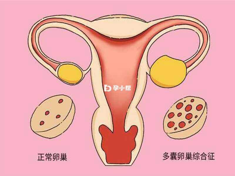 多囊需要一些方法提高怀孕几率
