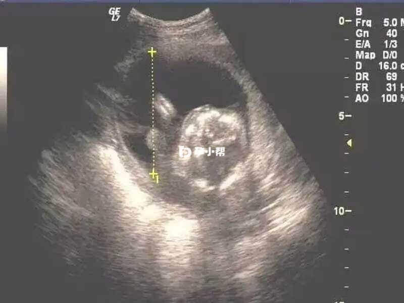 残角子宫术后是有怀孕可能