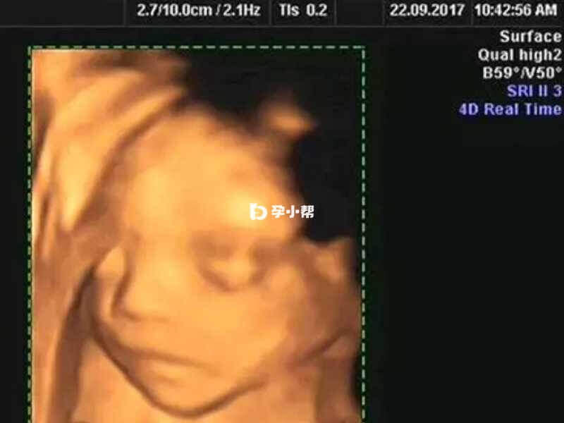四维图像预测胎儿性别不一定准确