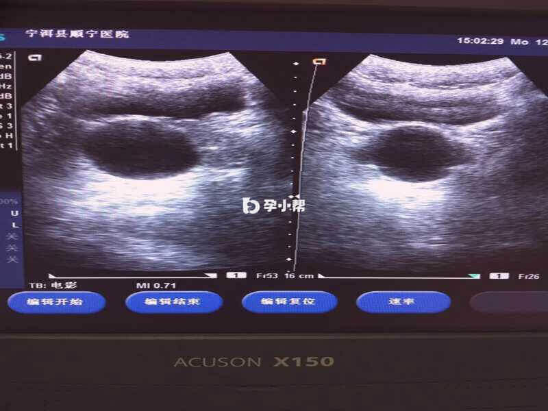 妇科三合诊检查可查看胚胎是否正常发育