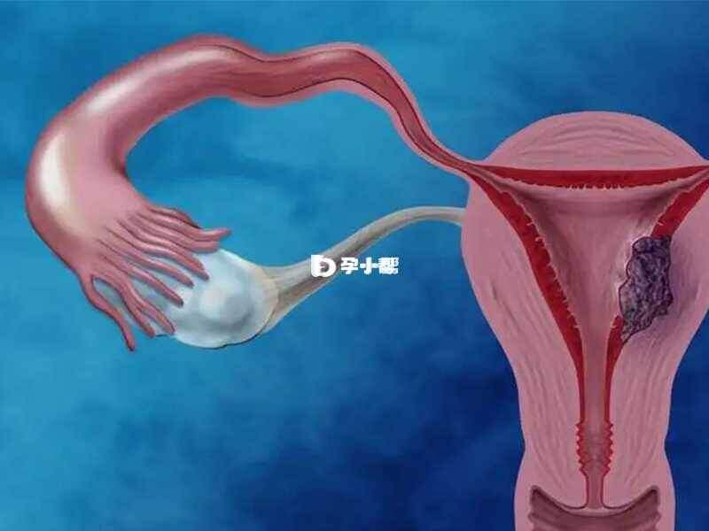 多囊卵巢综合征可能会导致子宫内膜癌