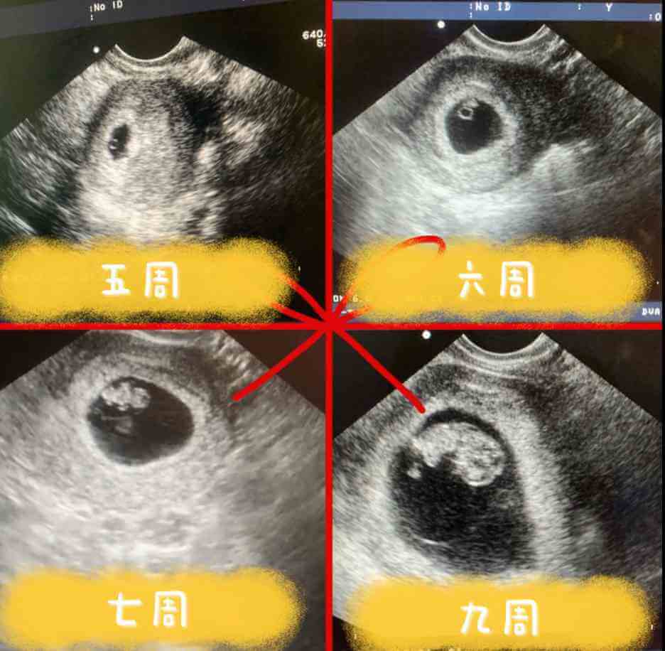 确定怀孕成功