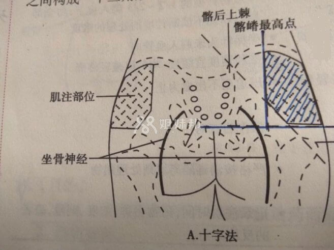 臀部注射部位