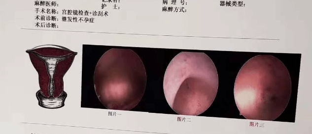 宫腔镜报告单