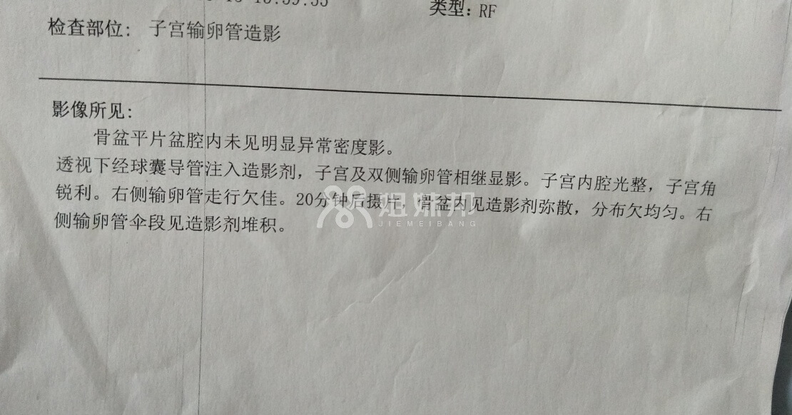 输卵管造影报告