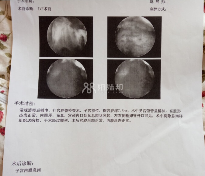 宫腔镜发现息肉