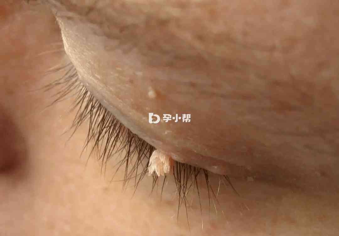感染丝状疣可以治愈