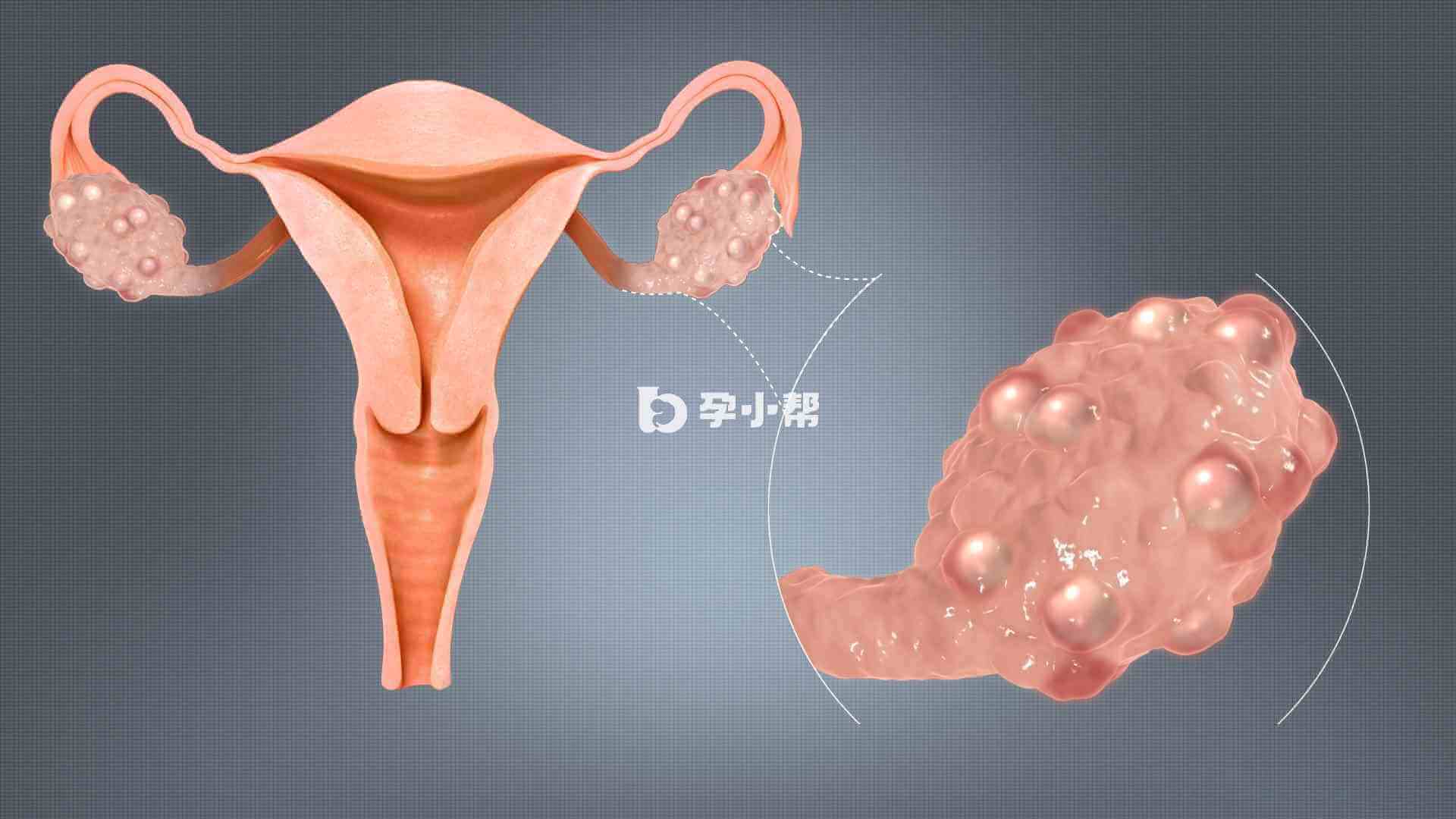 amh大于7可能是多囊卵巢综合征