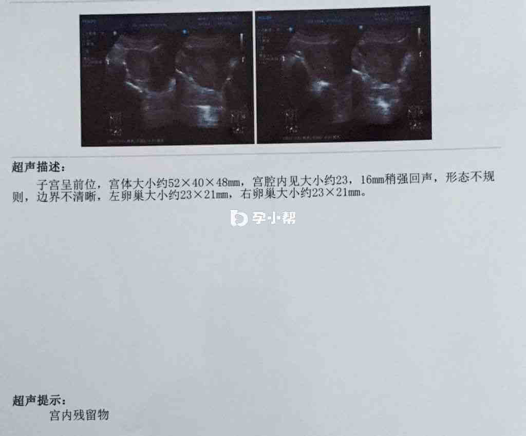 B超检查能在宫腔中看见孕囊