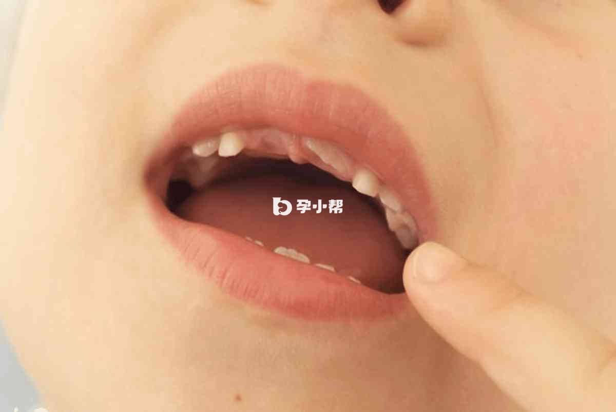 长期夜奶容易出现蛀牙