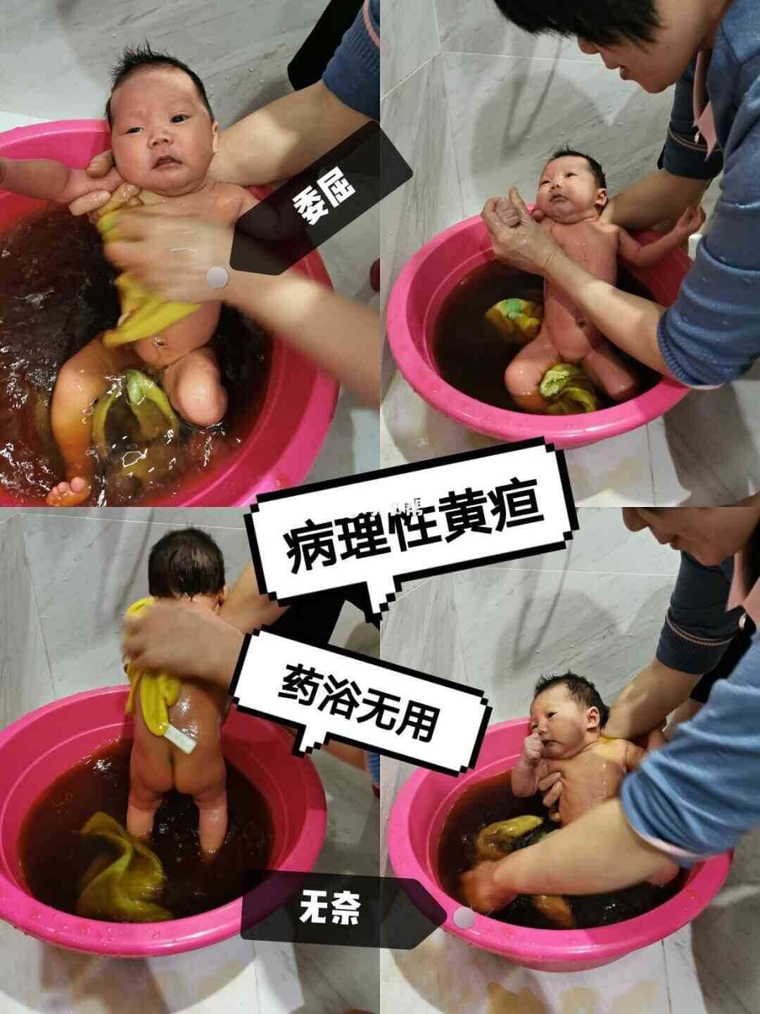 溶血性黄疸的注意事项