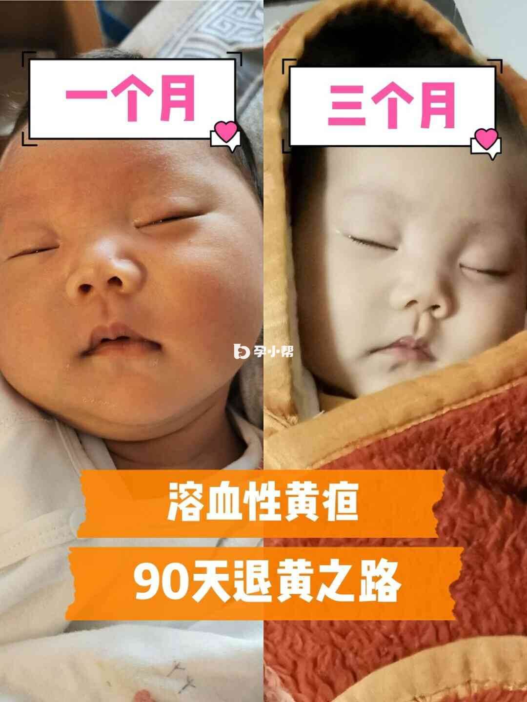 溶血性黄疸的治疗记录