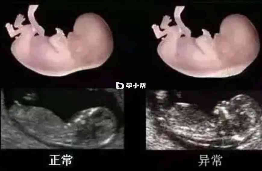 畸形胎儿对比图