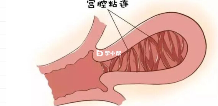 宫腔粘连