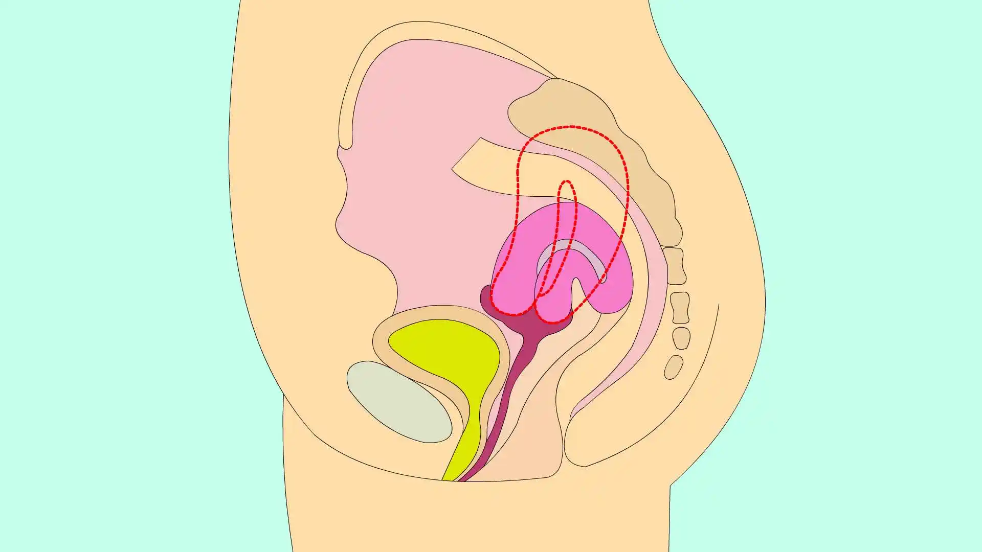 子宫前位是一种正常的子宫体位