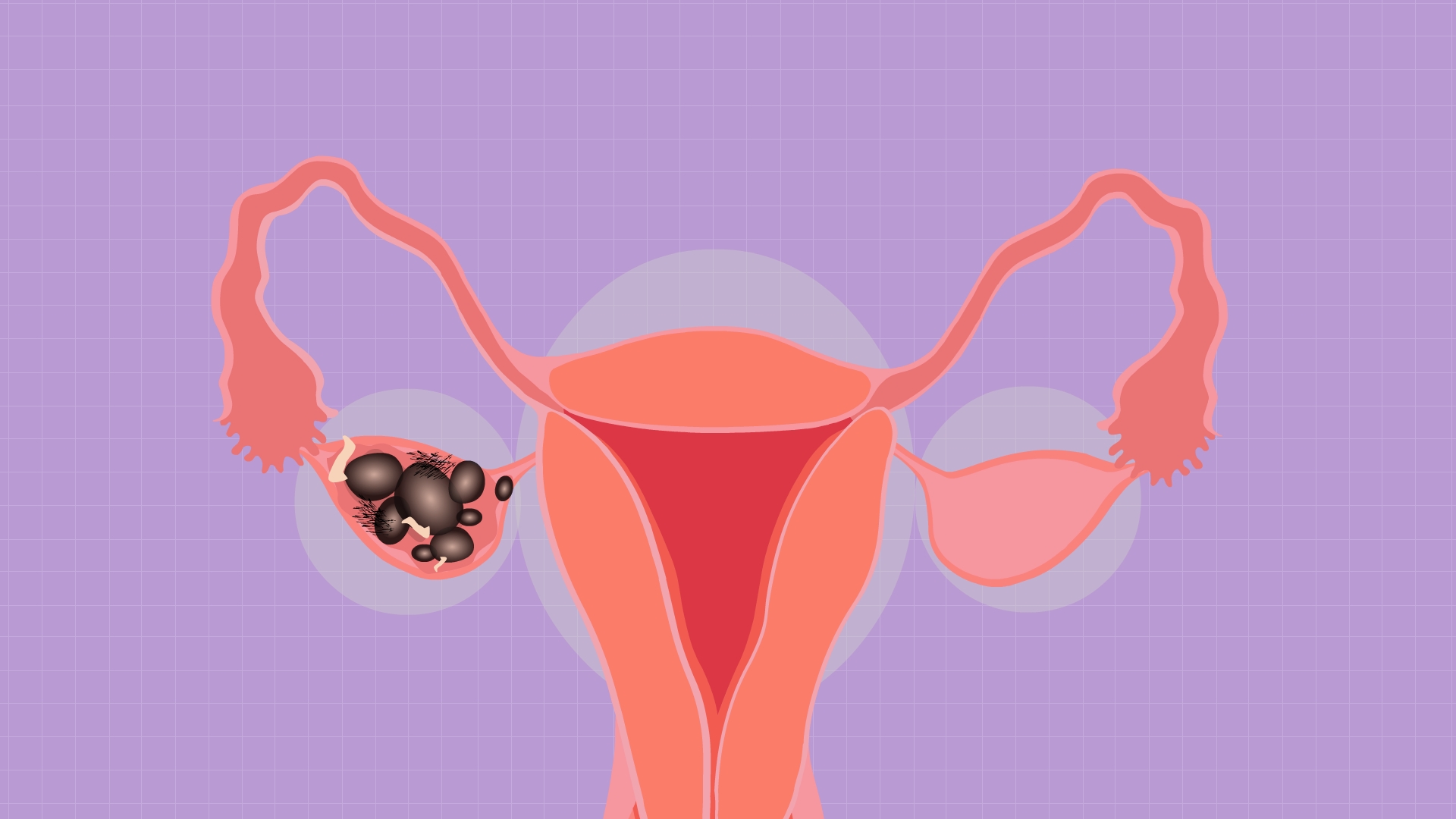 宫外孕是一种异常的妊娠状态
