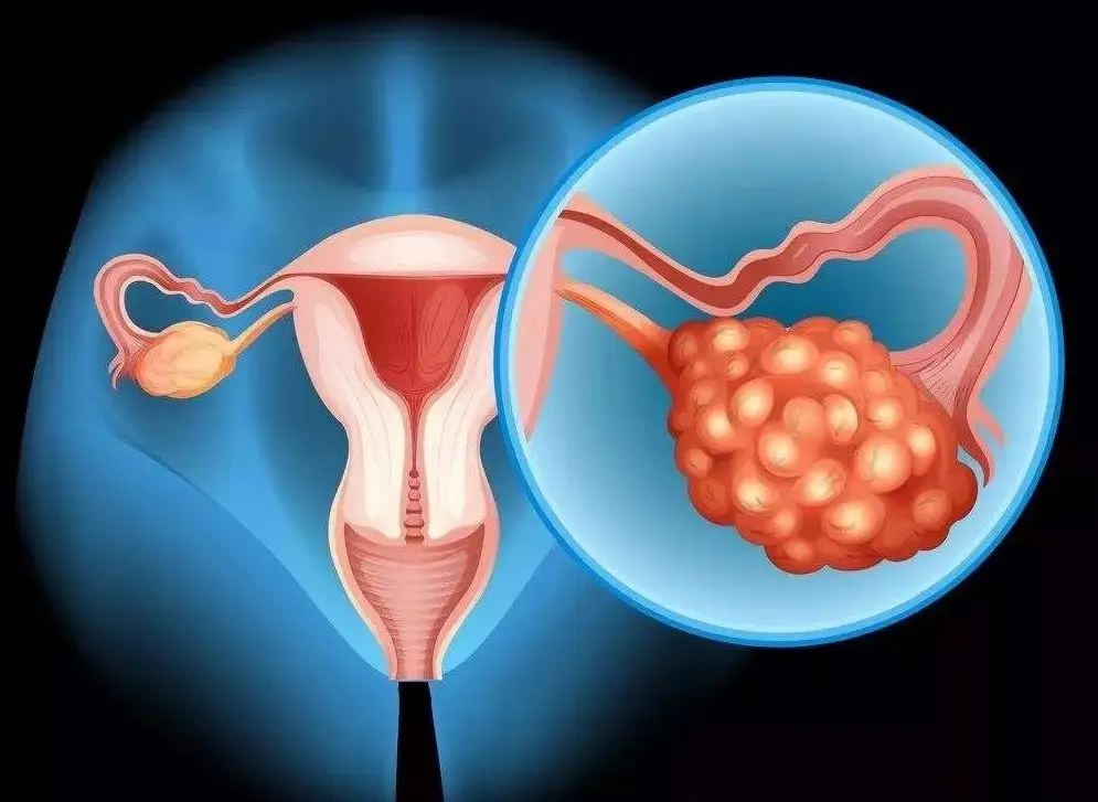 卵巢病变会引起女性不排卵