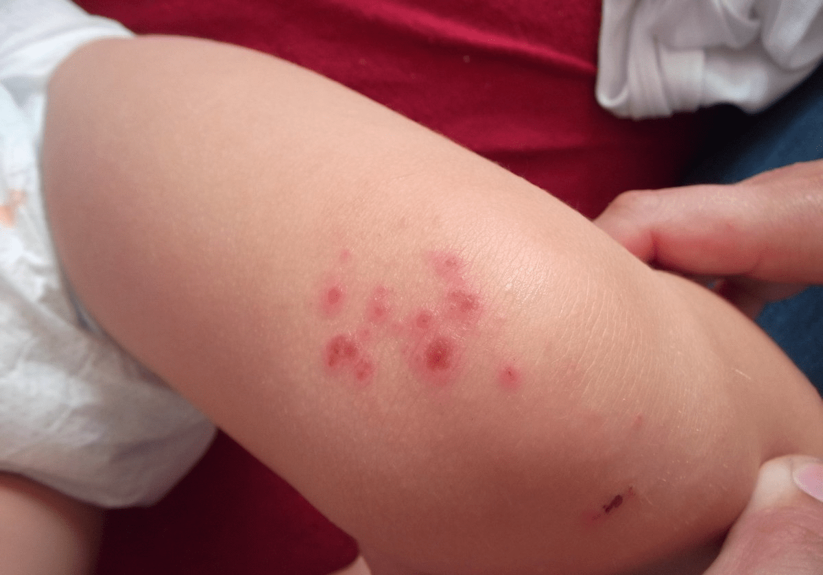儿童荨麻疹会导致四肢出现出现红斑