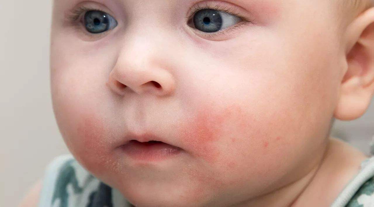 儿童荨麻疹患病年龄在2-7岁