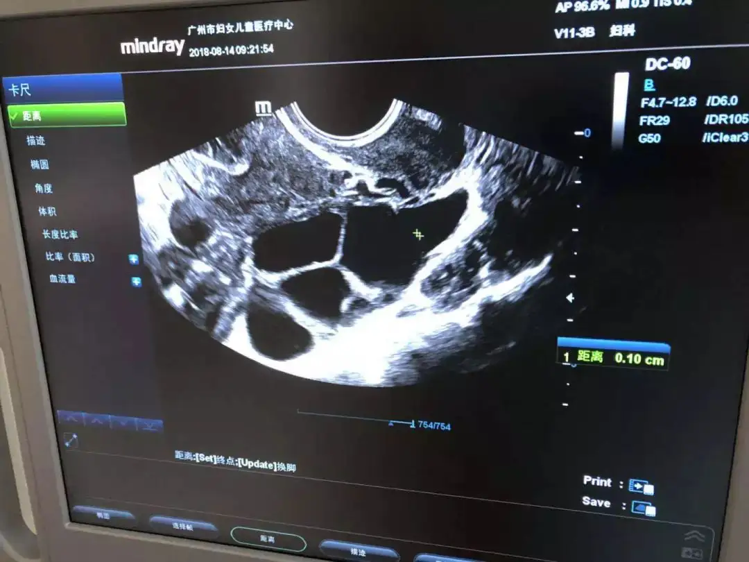 监测窦卵泡有腹部彩超和阴道超声两种方式