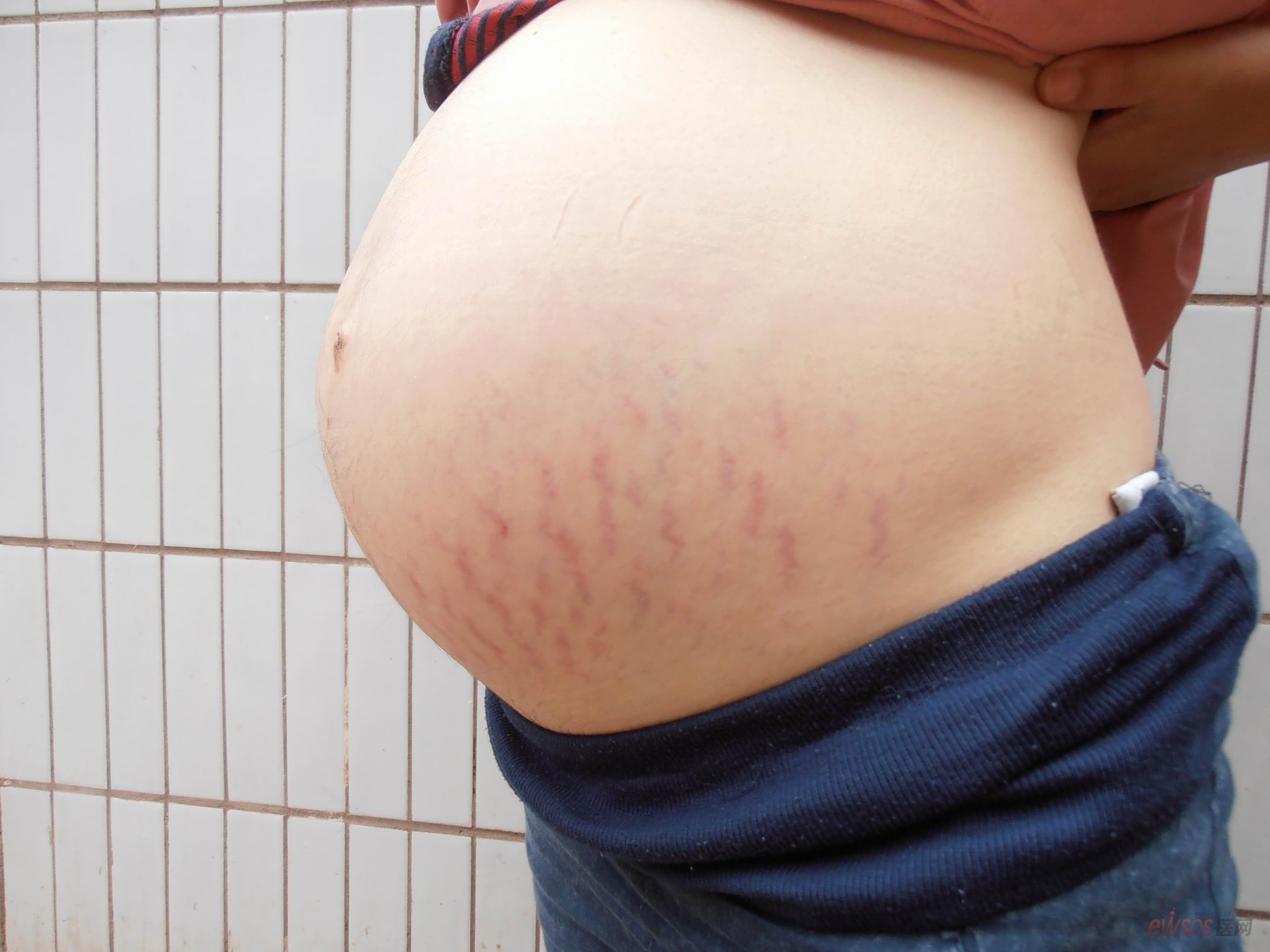 妊娠纹是由于弹性纤维破裂形成