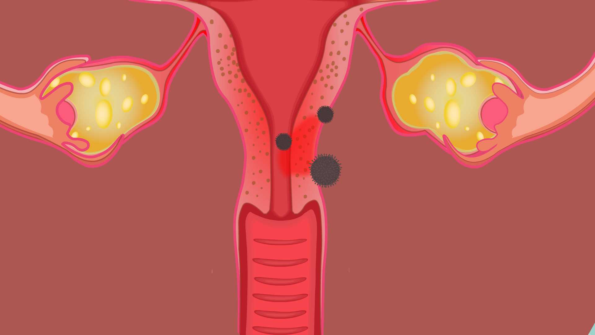 宫颈炎是一种常见的妇科疾病