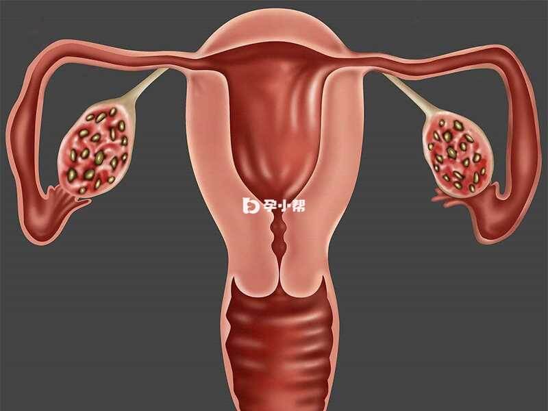 多囊卵巢可能表现为月经异常