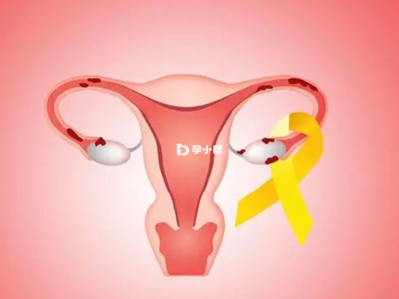 巧克力囊肿是否严重应该分情况讨论