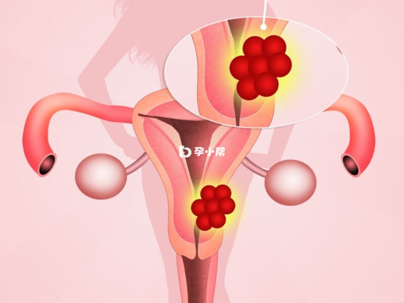 残角子宫是否需要做手术要分情况