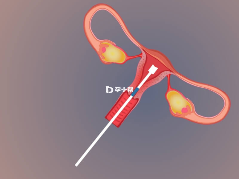 形成残角子宫的原因很多