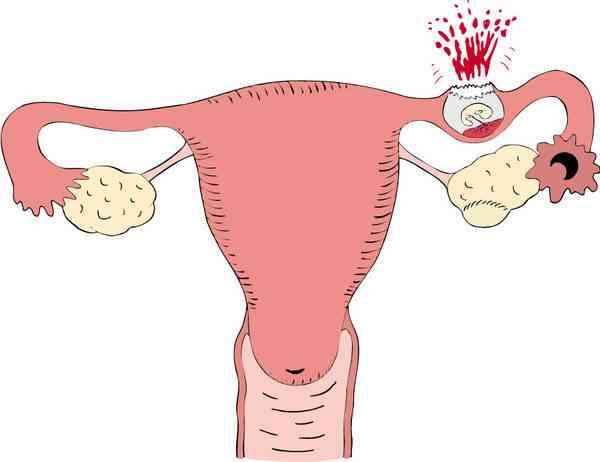宫外孕右侧输卵管切除左侧通畅还能自然怀孕吗