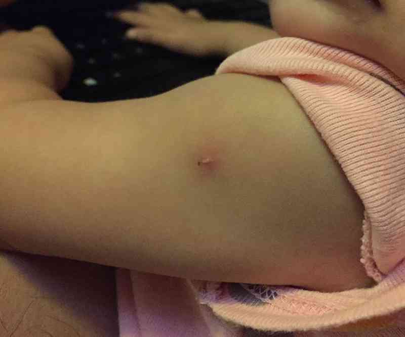 韩国卡介苗疤痕图图片