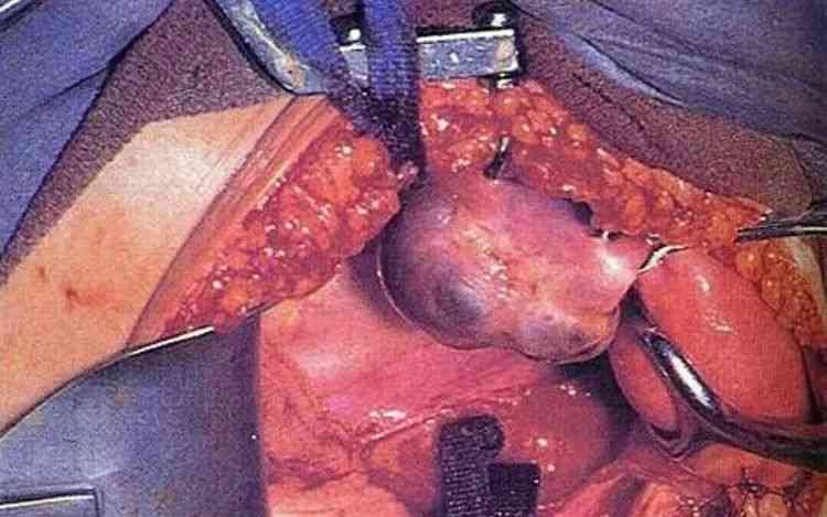 巧囊手术取出来的图片图片