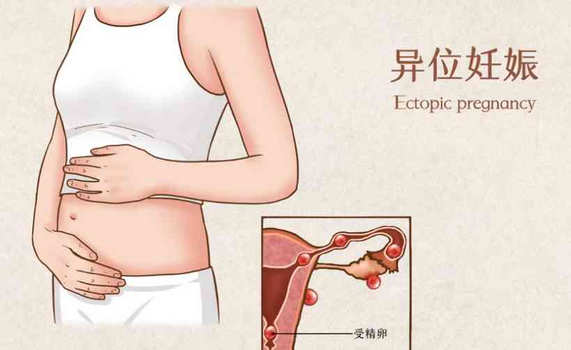 宫外孕最早几天会腹痛图片