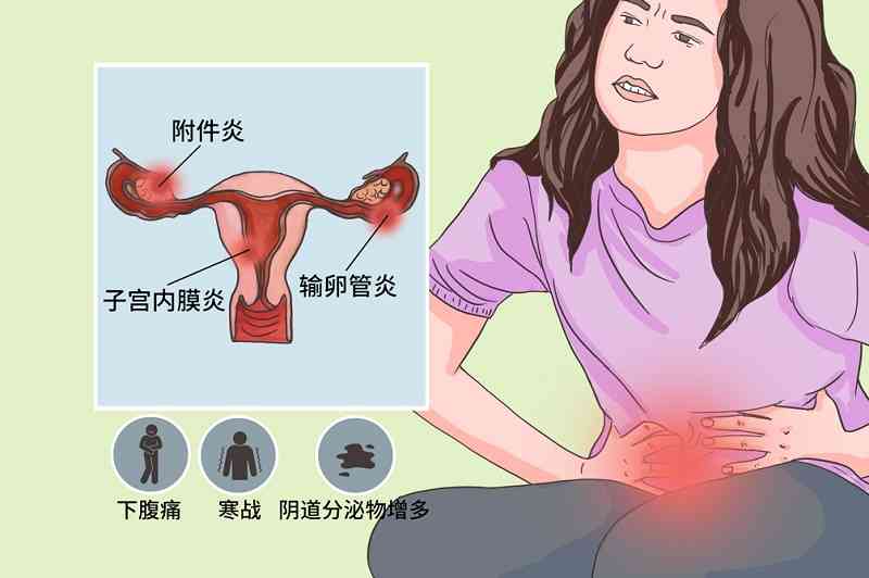 盆腔炎的症状图片