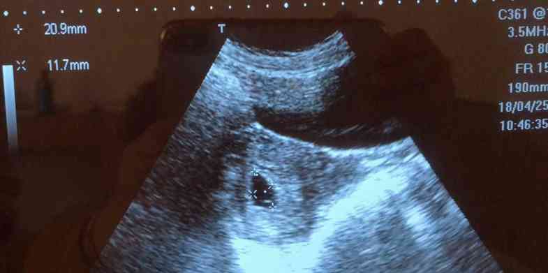 孕囊形状 男孩图片