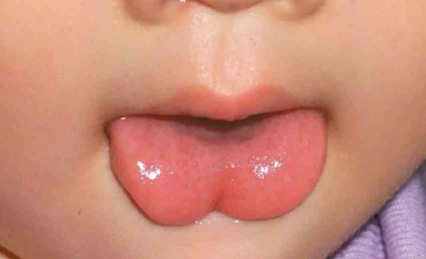 宝宝吃奶时发现舌头上有白色厚厚一层黏膜应该怎么清理