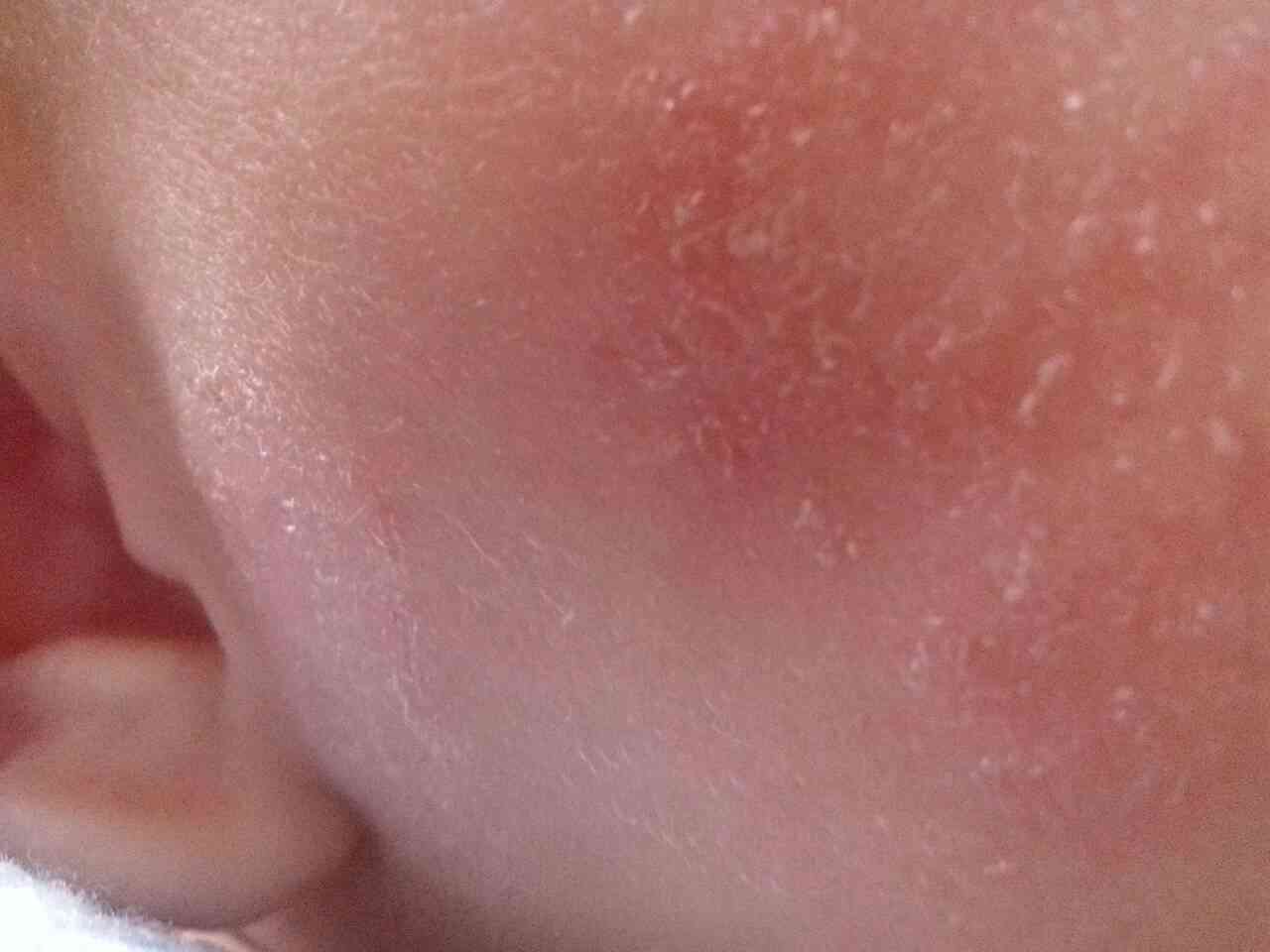 出生三个月的宝宝脸上皮肤干燥起皮发红医生建议擦什么好