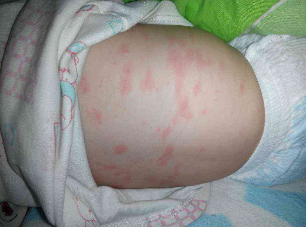 婴儿玫瑰疹是什么病常见的症状和表现有哪些
