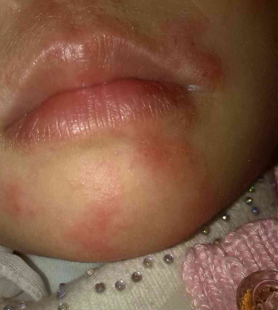 嘴巴湿疹的症状图片图片