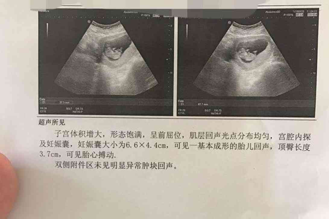 怀孕11周女孩彩超图图片