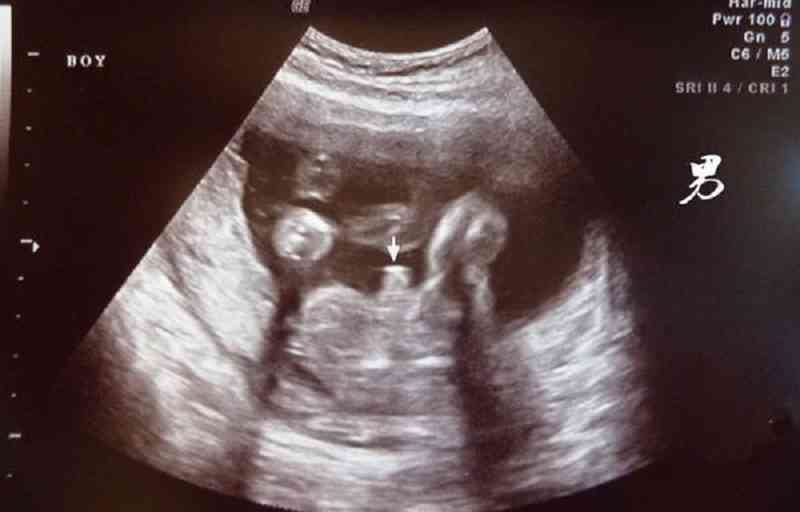 怀孕十二周男孩彩超图图片