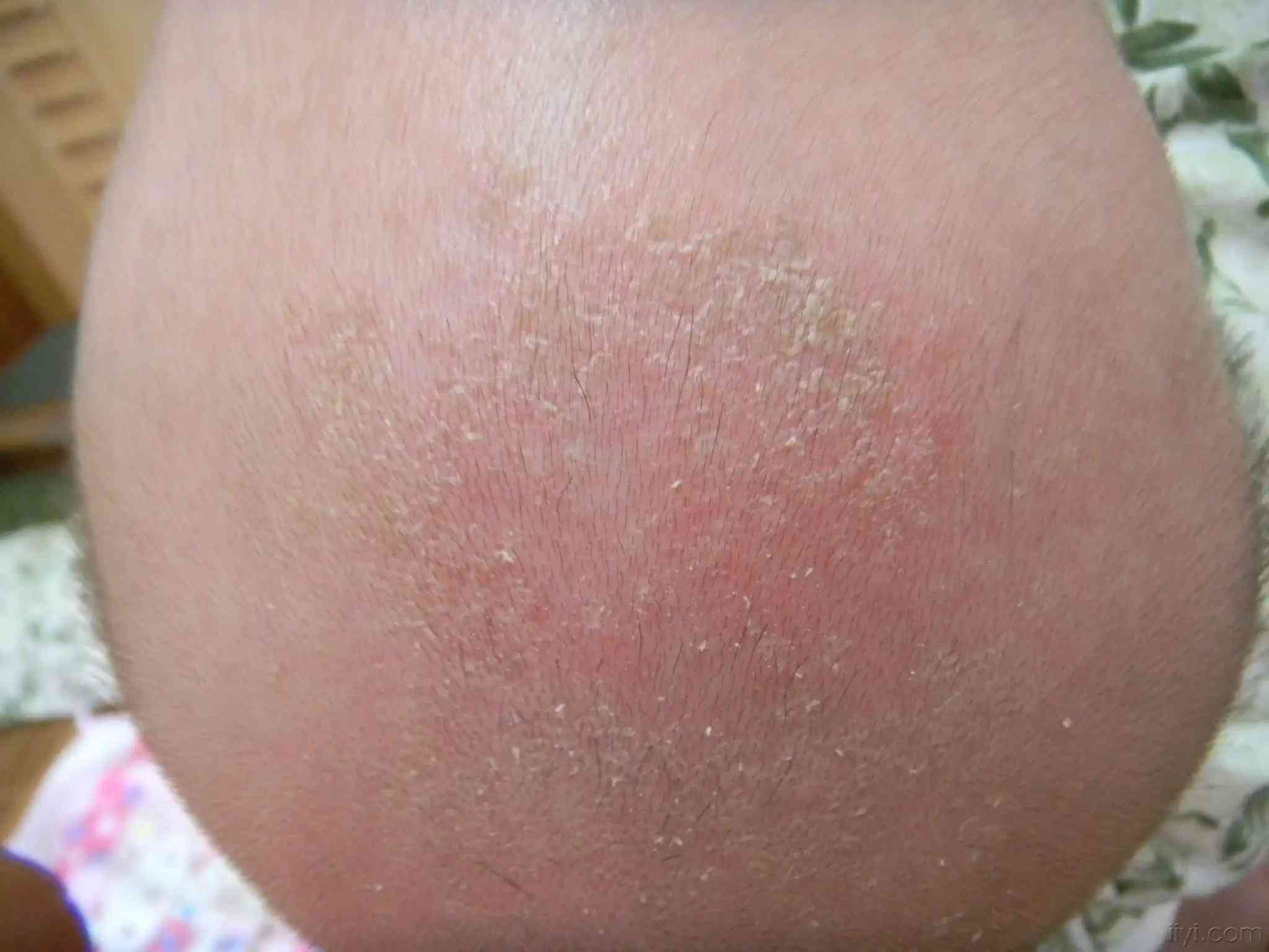 幼儿皮癣早期症状图片图片