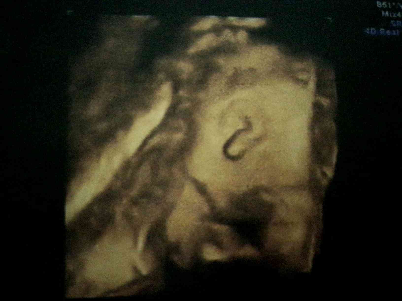 胎儿六个月四维彩超图片