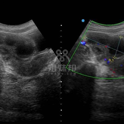 #输卵管积水