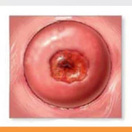 #宫颈肥大是怎么回事