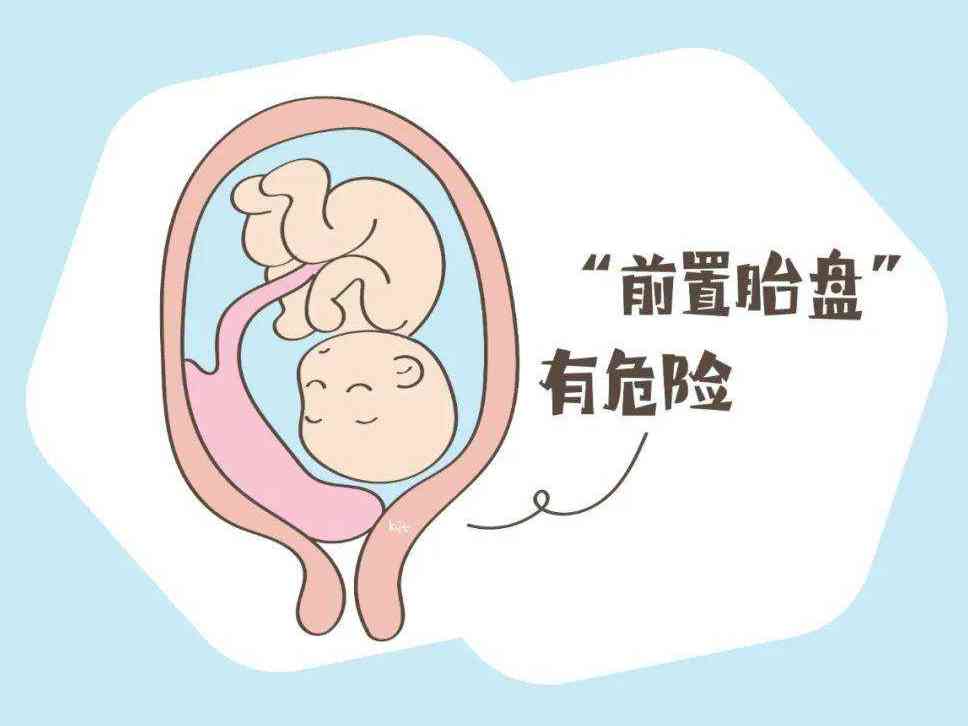 胎盘低置也叫前置胎盘
